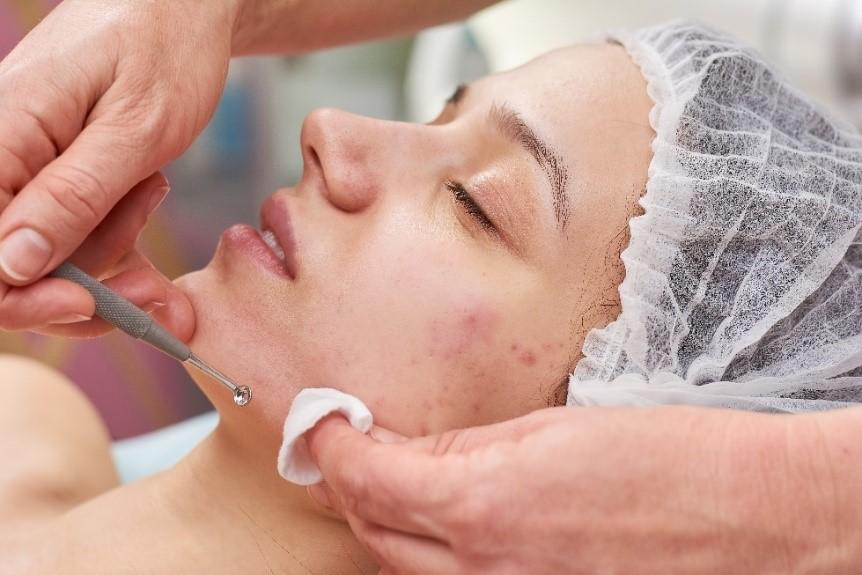 Microneedling